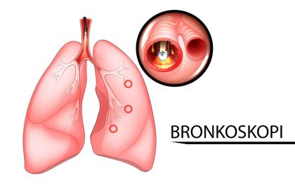 BRONKOSKOPI – 3-01 BRONKOSKOPI - 3-01