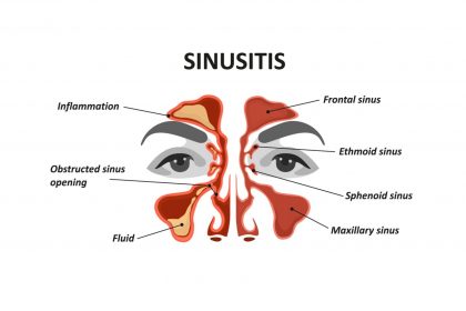 sering sakit kepala fb Sakit Kepala Karena Sinus